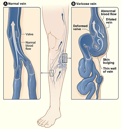 Varicose Veins Management: Understanding Symptoms, Causes, and Treatment  Options